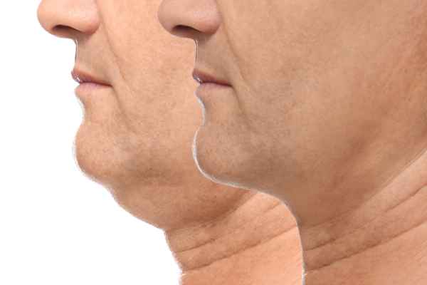 HIFU - Breakthrough in Anti - ageing 2 hifu results Hampton