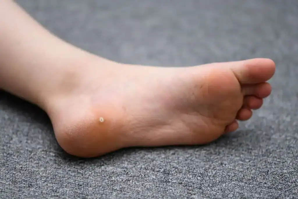 Cryotherapy For Warts And Also Verrucas 2 Image of verruca on the bottom of the foot that able to be treated with Cryotherapy Hampton