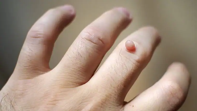 Image of blemish that Cryotherapy Hampton can remove with Lipo 360.