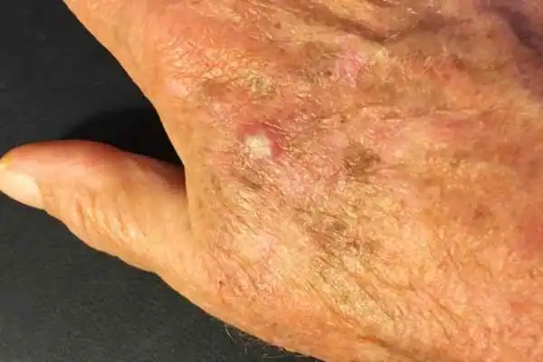Cryopen For Actinic Keratoses 1 Image of Actinic keratoses Hampton on a person hand