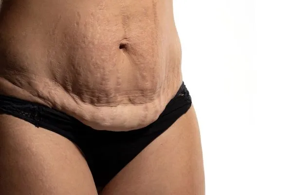 The Science of Skin Tightening 1 The science behind skin tightening Hampton picture of a woman's sagging skin on the stomach